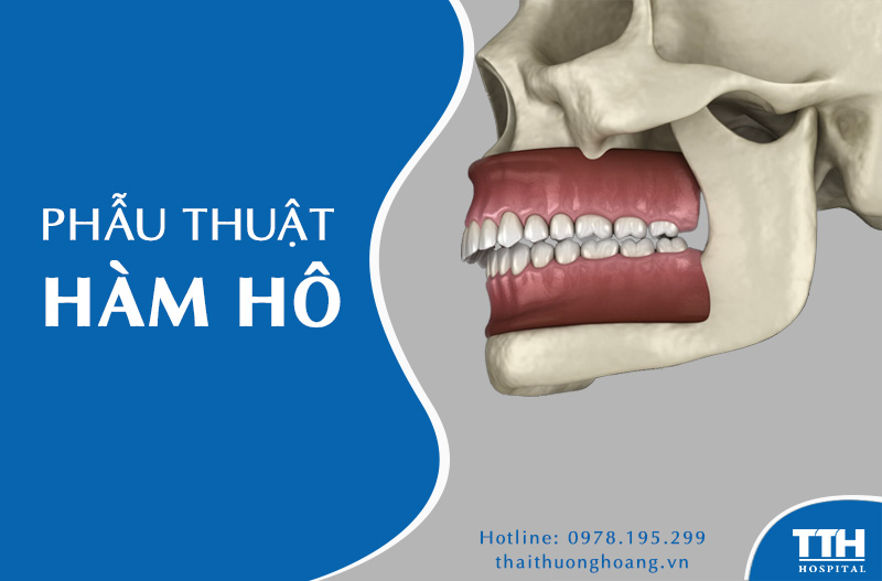 Phẫu thuật hàm hô là gì?
